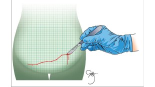 loksatta chaturnag An increase in the rate of caesarean or surgical deliveries