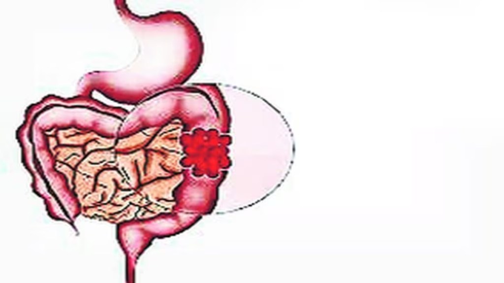 Misconceptions rectal cancer World Cancer Day higher rates akola health