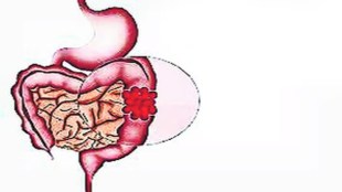 Misconceptions rectal cancer World Cancer Day higher rates akola health