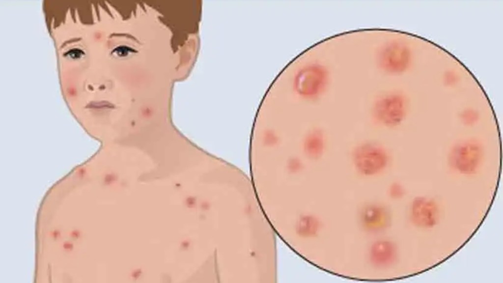 nagpur chickenpox marathi news, nagpur chickenpox spread marathi news nagpur chickenpox marathi news, nagpur chickenpox spread marathi news