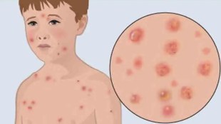 nagpur chickenpox marathi news, nagpur chickenpox spread marathi news