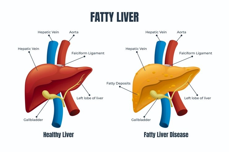 fatty-liver-symptoms 