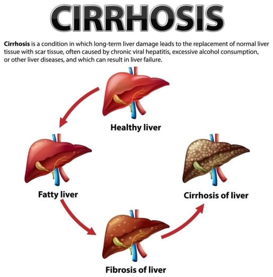fatty-liver-symptoms 