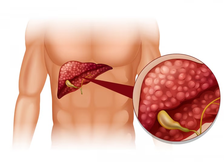 fatty-liver-symptoms 