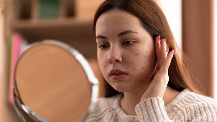 Moong Dal Can Be Your Best Beauty Buddy 