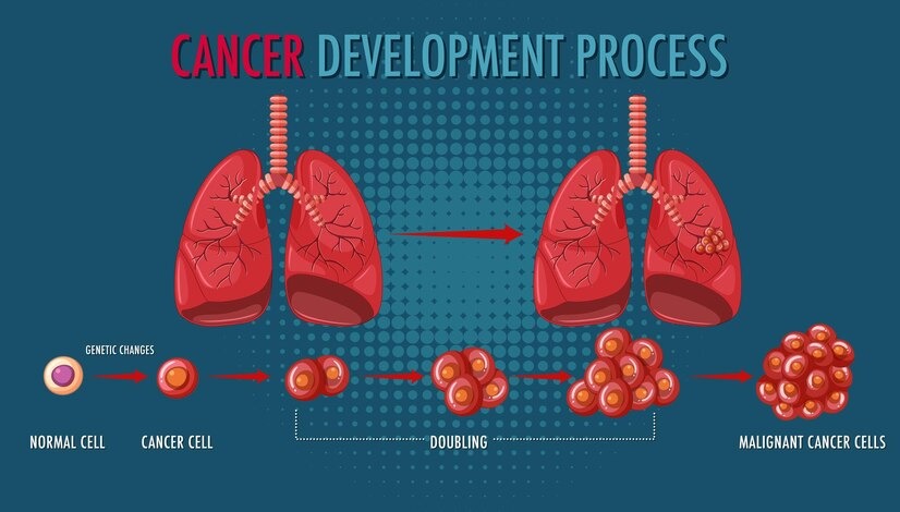 symptoms-of-lung-cancer