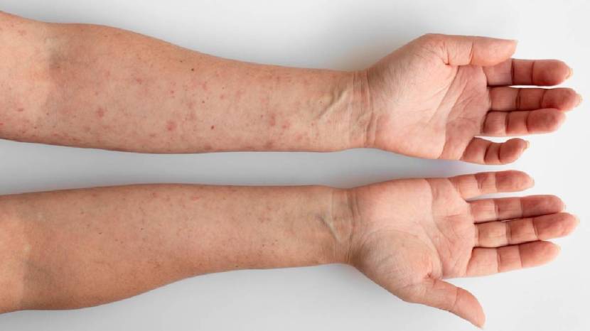 Are Rashes Troubling You Here are Five Natural Home made Remedies To Beat Your Heat Rash must follow
