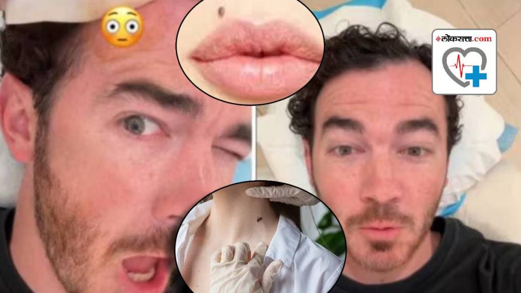 Never Ignore These Changes In Your Mole On Skin Priyanka Chopra Brother in Law Kevin Jonas Skin Cancer Never Ignore These Changes In Your Mole On Skin Priyanka Chopra Brother in Law Kevin Jonas Skin Cancer