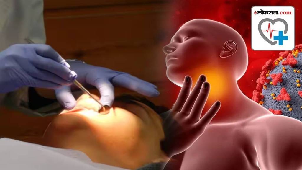 Early Signs Of Oral Cancer Early Signs Of Oral Cancer