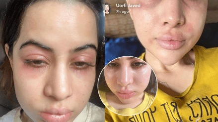 Urfi Javed shared an allergy photo with a swollen face said doing Botox since 18 years old Urfi Javed shared an allergy photo with a swollen face said doing Botox since 18 years old