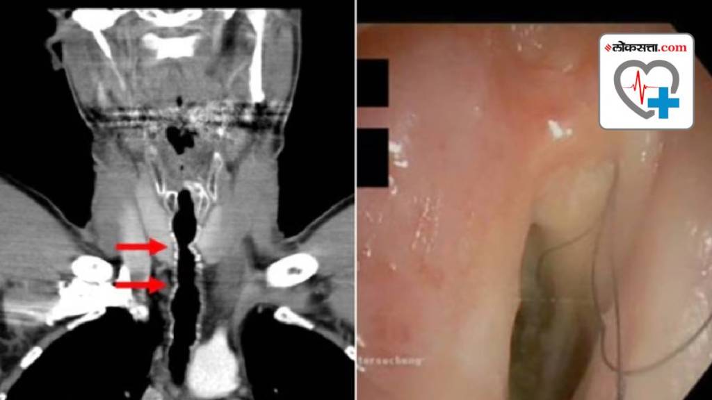 Hair Grown Inside Throat