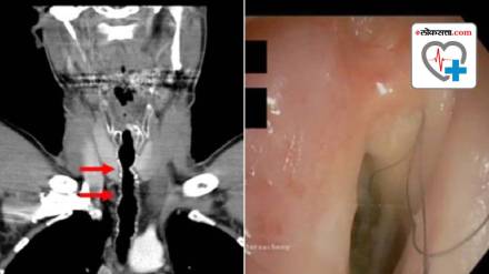 Hair Grown Inside Throat