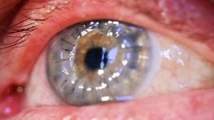 40 patients waiting for corneal transplant in Nagpur 40 patients waiting for corneal transplant in Nagpur