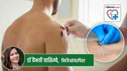 pain relief, dry needling, physiotherapy, exercise, lifestyle changes, neck pain, chronic pain, pain management, posture improvement, patient education,