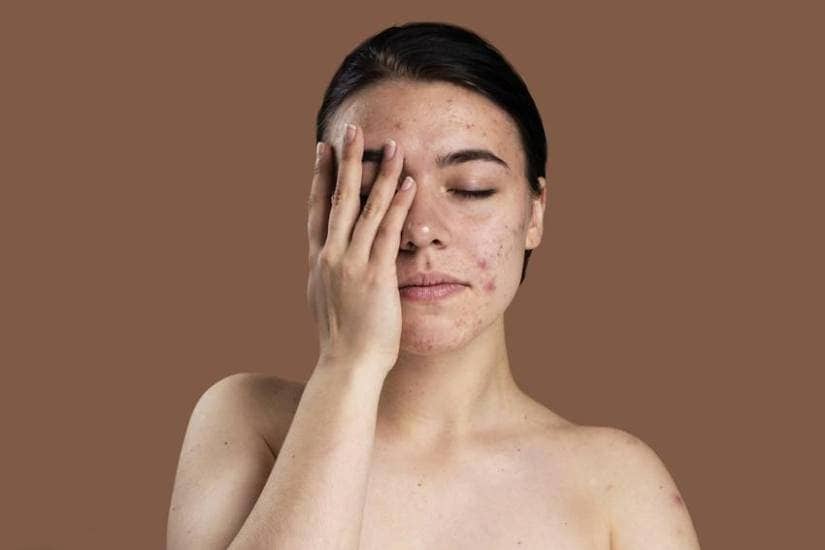 Method of applying neem on face