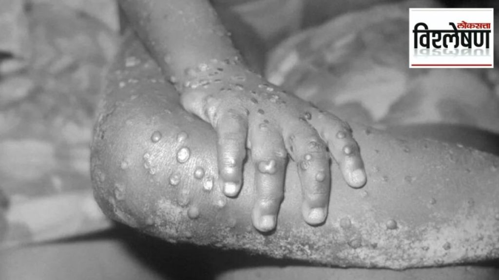 monkeypox india