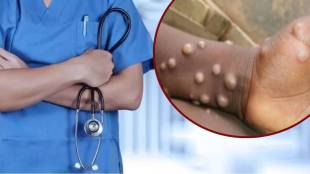 monkeypox virus global emergency Cases found in Sweden, Pakistan; Symptoms, transmission
