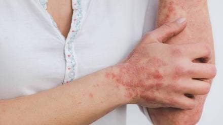 effective treatment on psoriasis with side effects advice from dermatologist