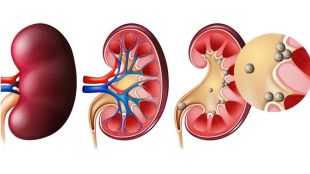 kidney-stone-causes-food