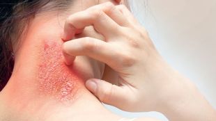 skin care during monsoon season