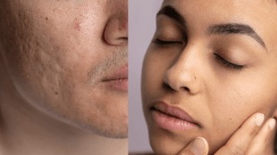Open pores home remedies effective and natural treatment to treat Open pores