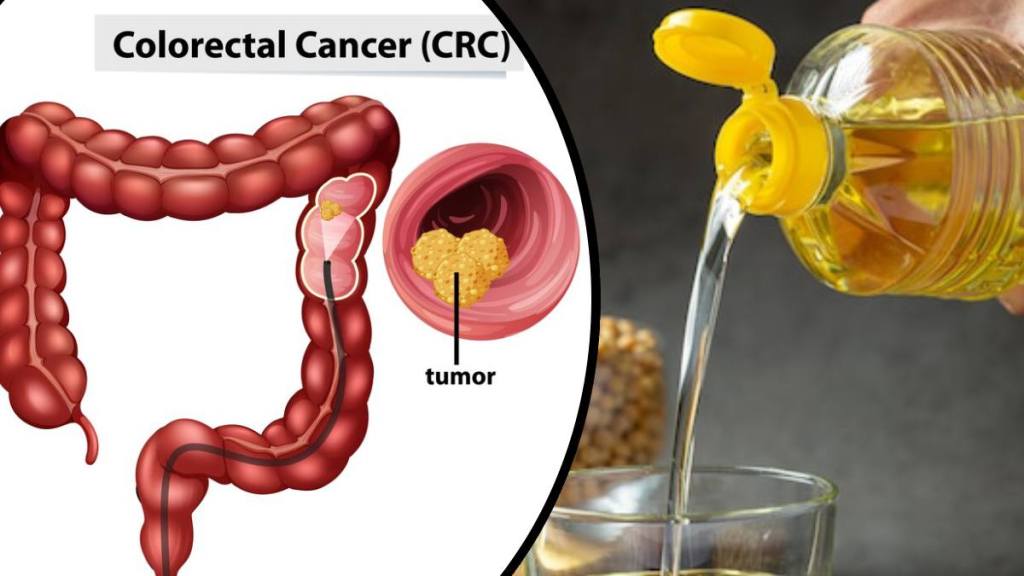 Common cooking oil fueling colon cancer in young Americans: What a new ...