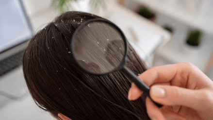 dandruff remedy Dandruff home remedies use this ingredient to get rid of Dandruff this winter