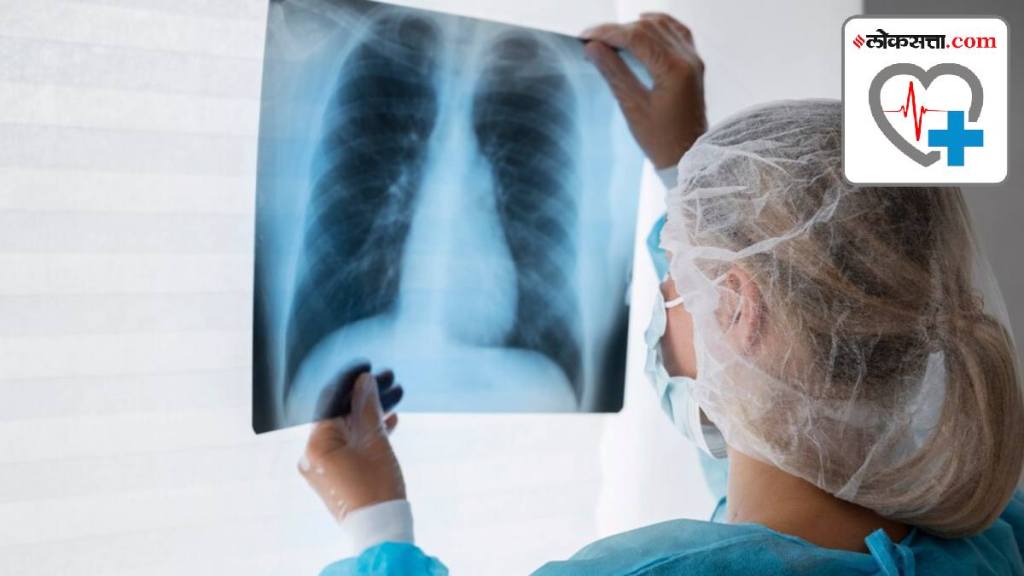 Why does lung cancer recur? It’s all in the genes, finds new study lung cancer early symptoms Why does lung cancer recur? It’s all in the genes, finds new study lung cancer early symptoms