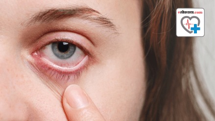 What is dry eyes Disease What is dry eyes Disease