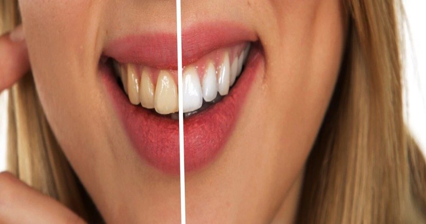 teeth whitening tips in marathi