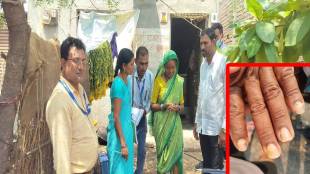 Hair loss, nail loss , Shegaon, villages, nail ,