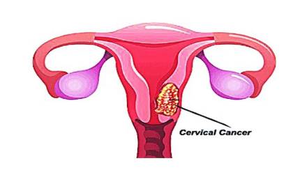 AIIMS develops cervical cancer test to help beat cancer