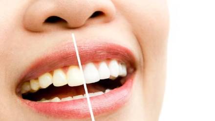 How to make teeth whiter