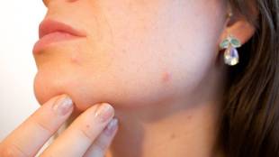 Best Skincare For Pimples