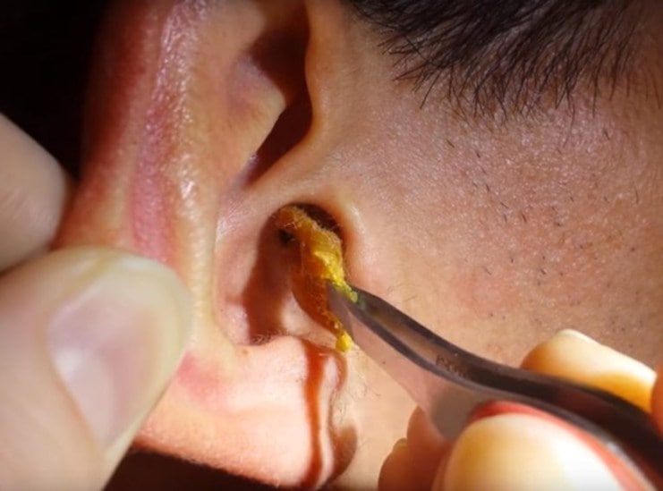 Earwax build-up symptoms