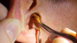 Symptoms of excessive earwax in ears