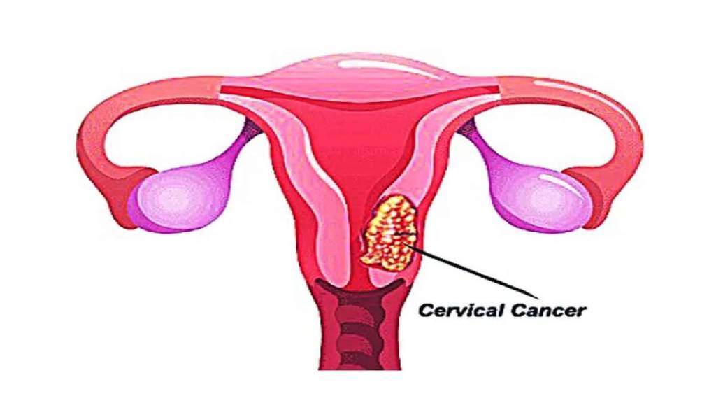 AIIMS develops cervical cancer test to help beat cancer