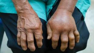 Palghar reports 2519 snakebite cases in 12 months averaging 6 7 bites daily