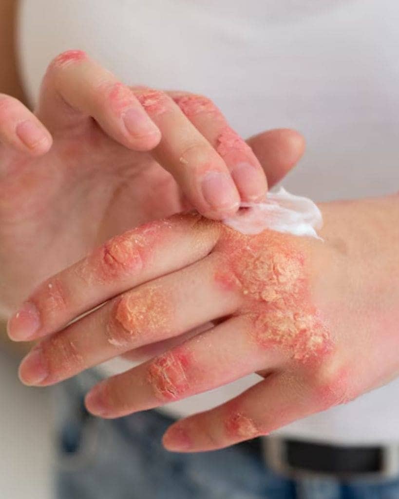 fungal infections