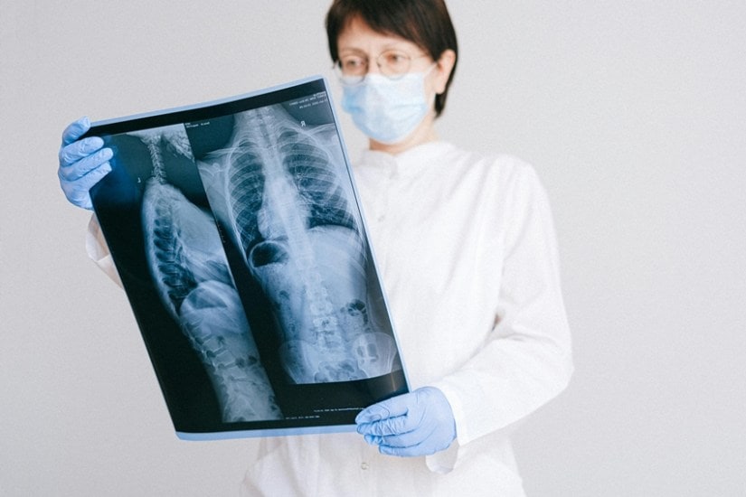 Amrita Hospital Doctors Straighten 50-Degree Spine Curve in Remarkable Surgery