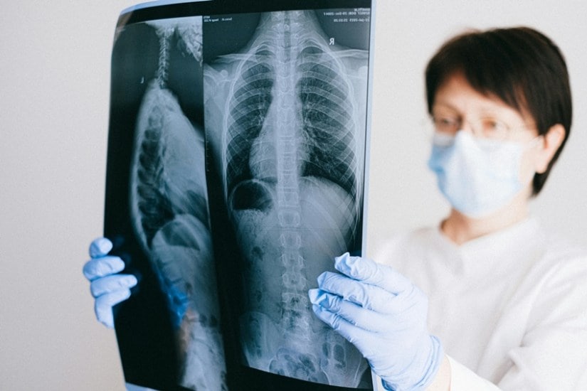 From Curve to Confidence 13-Year-Old Noida Girl Beats Scoliosis in Just 5 Days