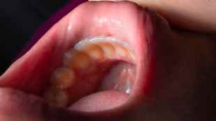 How to Remove Yellow Teeth Stains at Home