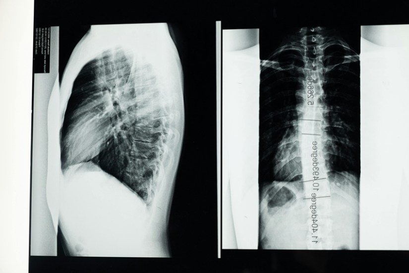 Life-Changing Spine Surgery Helps Noida Girl Walk Tall Again