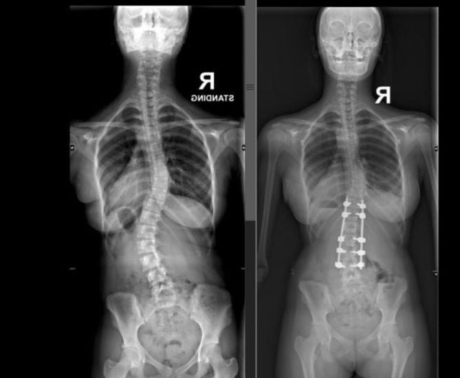 Scoliosis Strikes 7 Times More Girls Than Boys Noida Teen Recovers After Complex Surgery