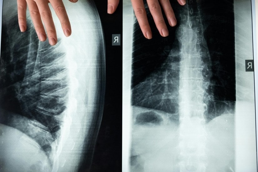 Scoliosis Surgery Success How Amrita Hospital Gave a New Life to a Teenager