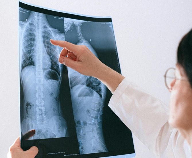 Scoliosis in Adolescents A Silent Threat with Deep Physical and Mental Impact