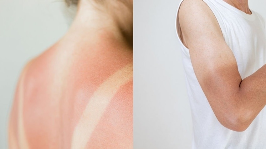 Sun Tan Remedies