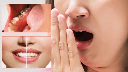 Oral health teeth cavity bad breath yellow teeth's start eating dairy products fruits