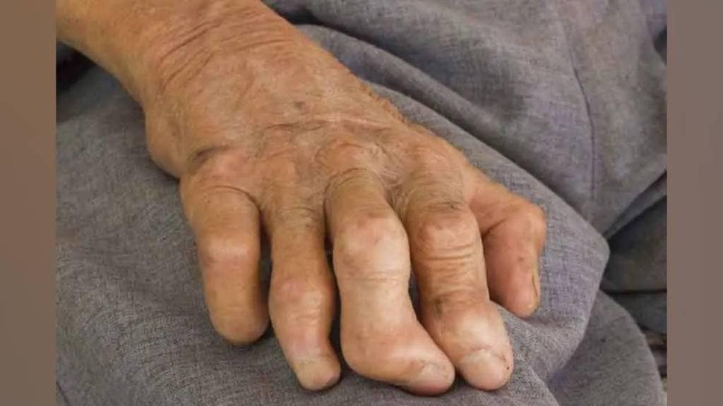 Public health department to form state committee for leprosy eradication