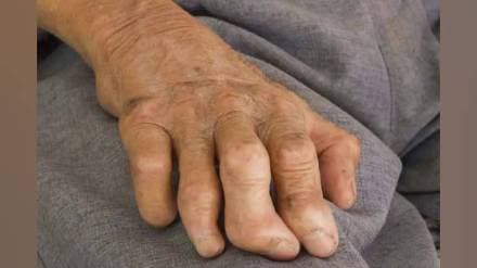 Public health department to form state committee for leprosy eradication